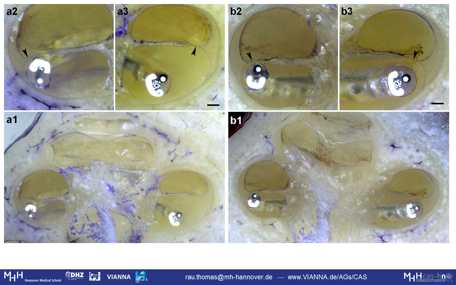 Pictures showing no insertion trauma when using an electrode array equipped with an additional Nitinol wire.